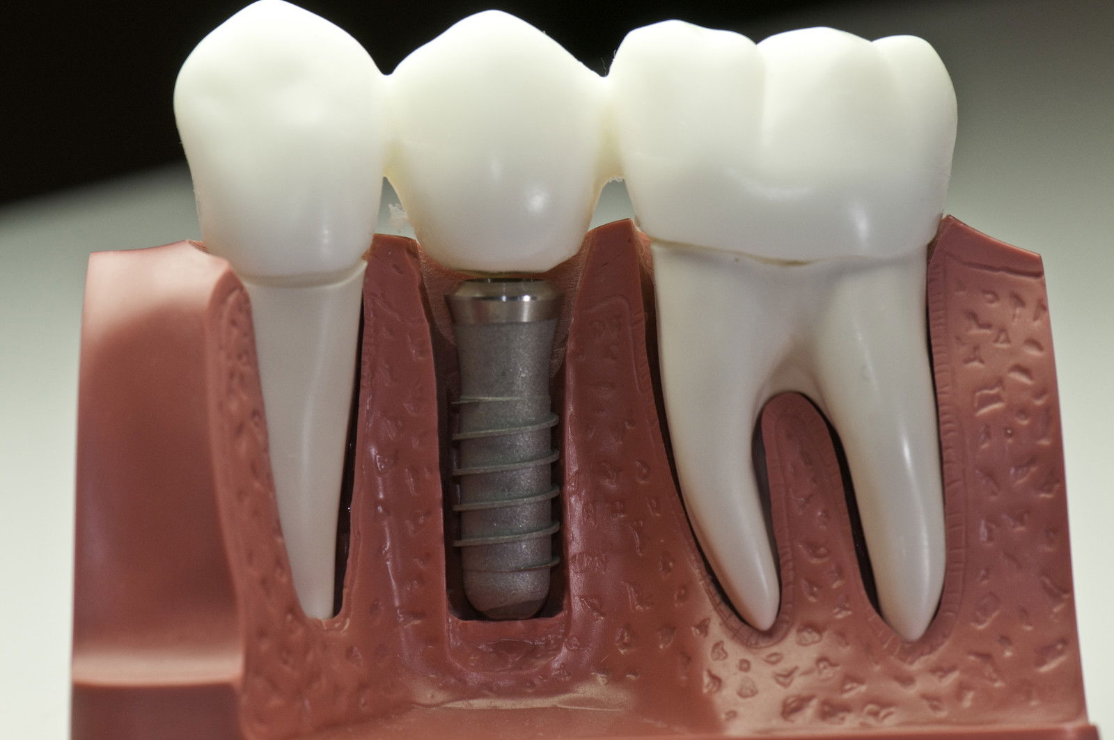 The Pros and Cons of Dental Implants