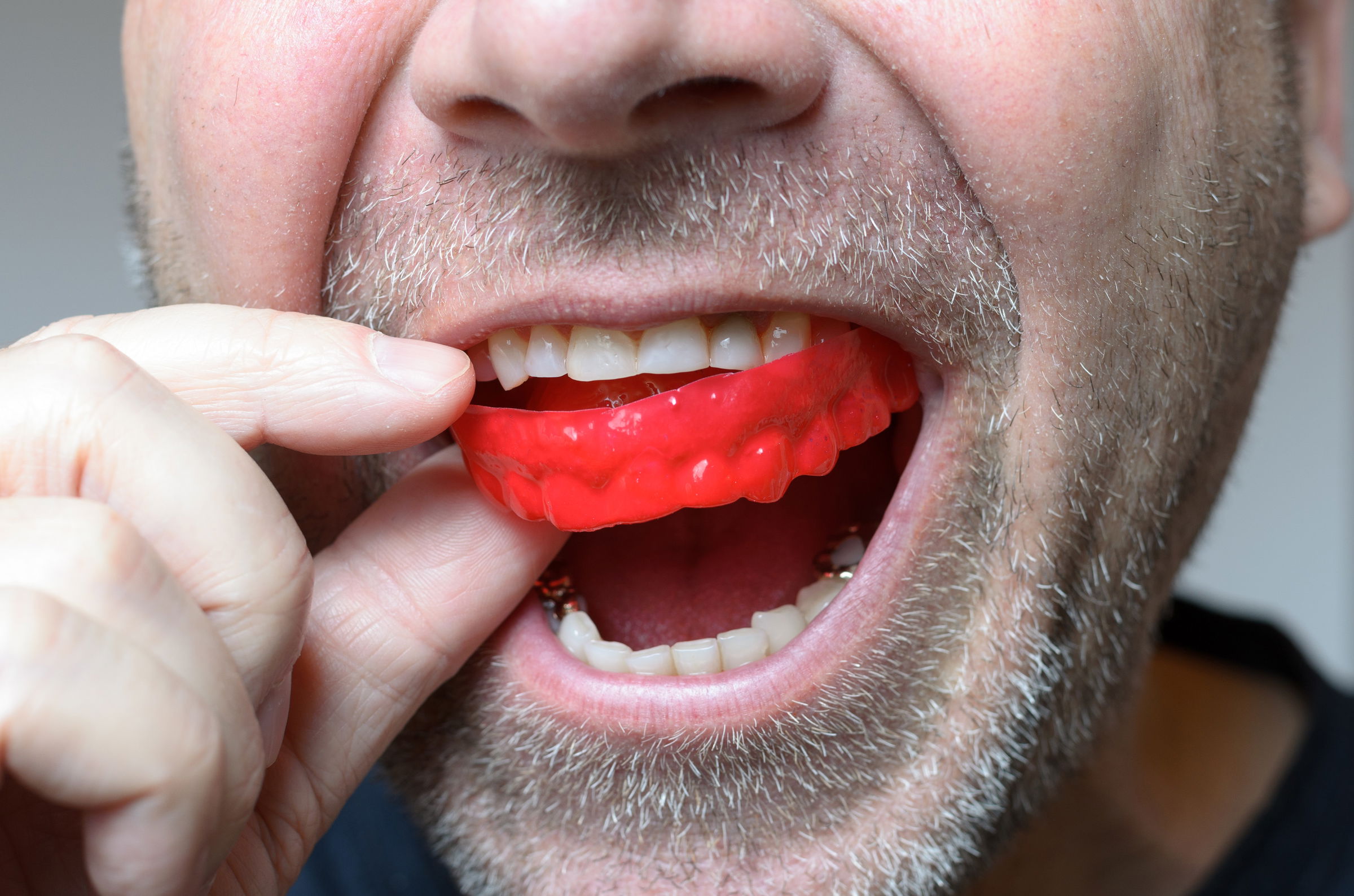 Mouth Guard in Edmonton