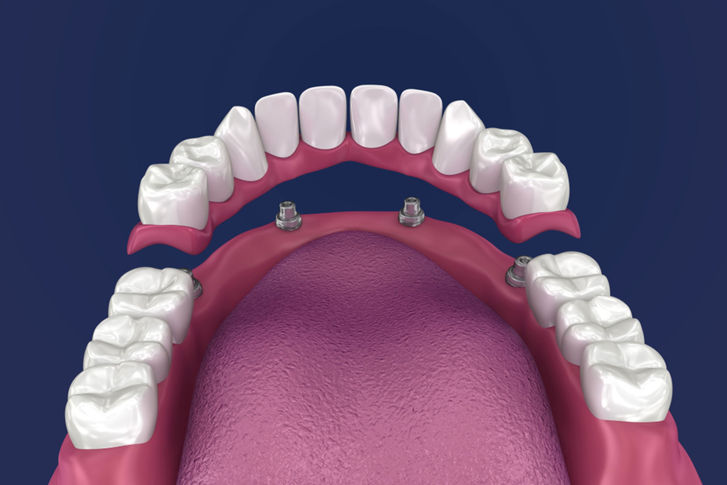 Why Dental Implants Are Becoming So Popular