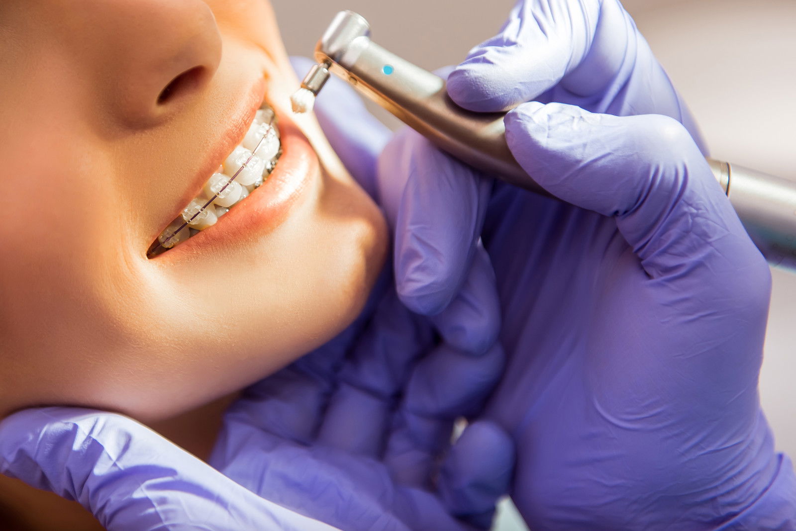 Tips for Brushing Your Teeth with Braces