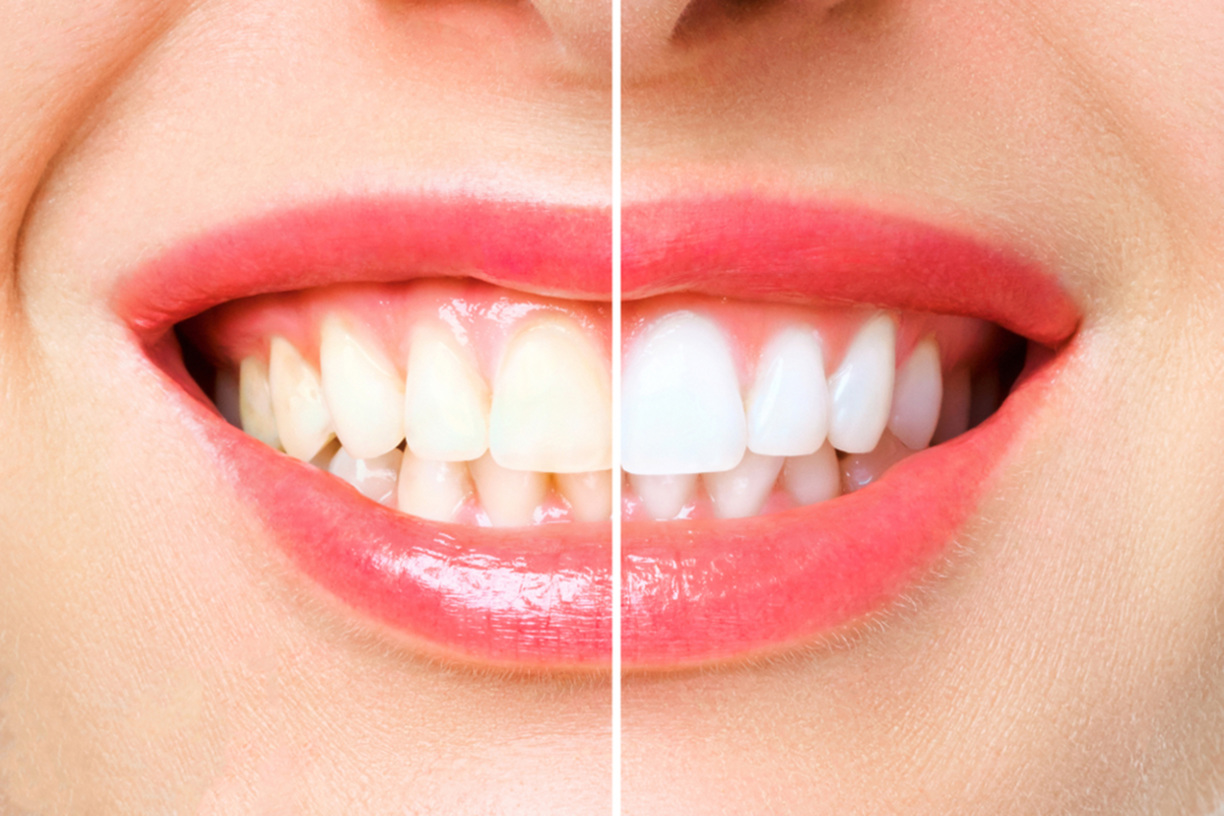 is teeth whitening safe find out how it is done